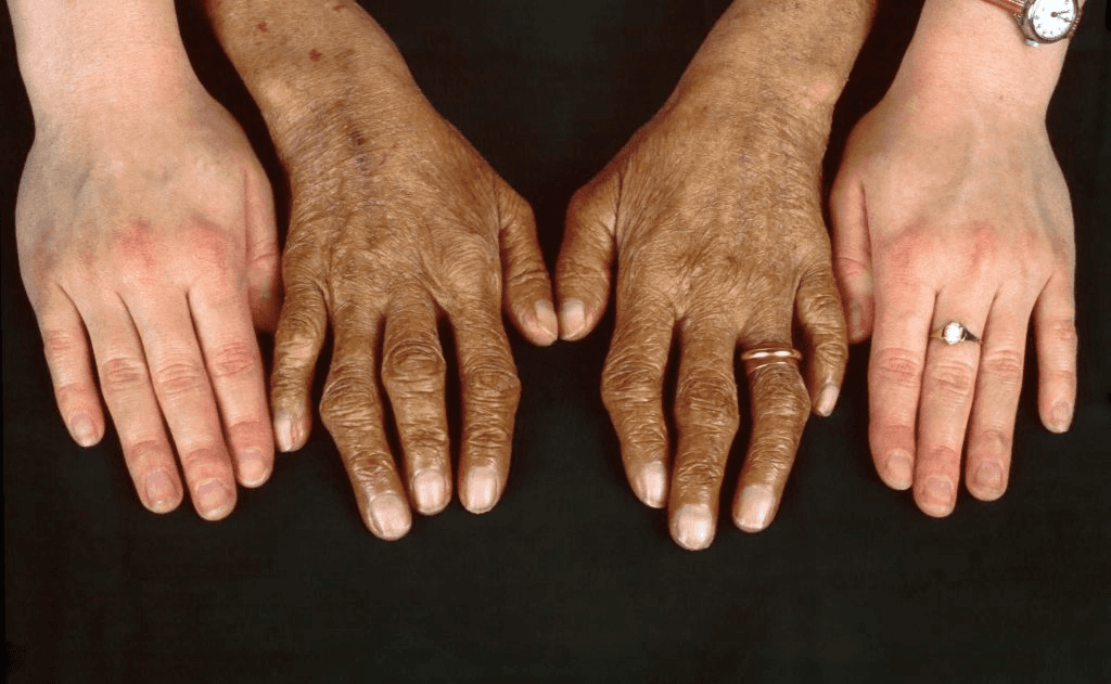Zaawansowana hemochromatoza.