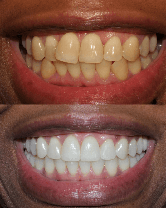 Invisalign Treatment at ScarboroSmiles Before and After at ScarboroSmiles Dental Clinic in Scarborough, ON | Best dentist in Scarborough, ON.