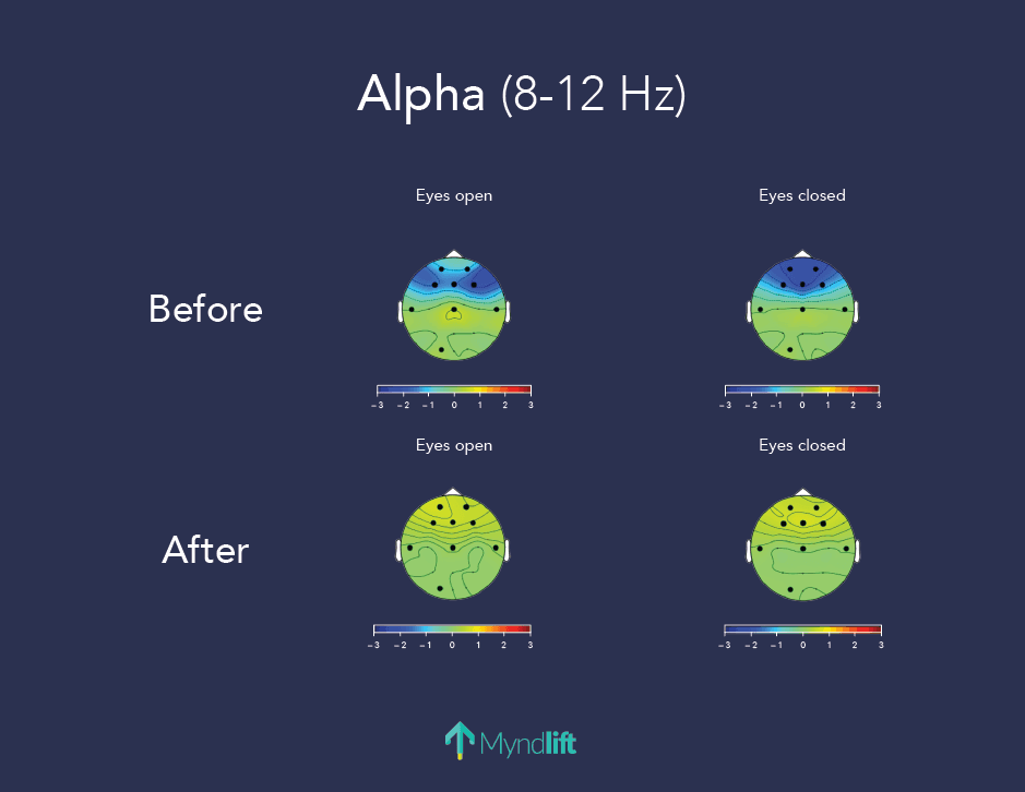 The improvement of spatial patterns of brainwaves after neurofeedback training with Myndlift