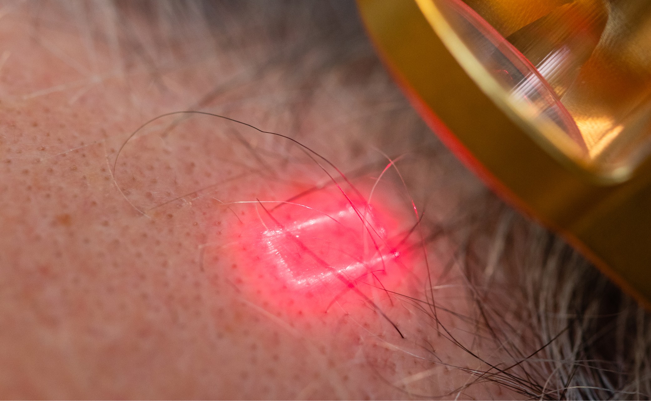 FoLix Laser outline at scalp