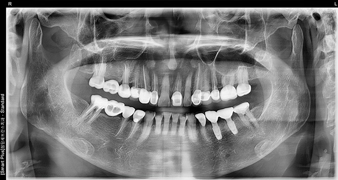 풀 셋팅 후 파노라마사진
