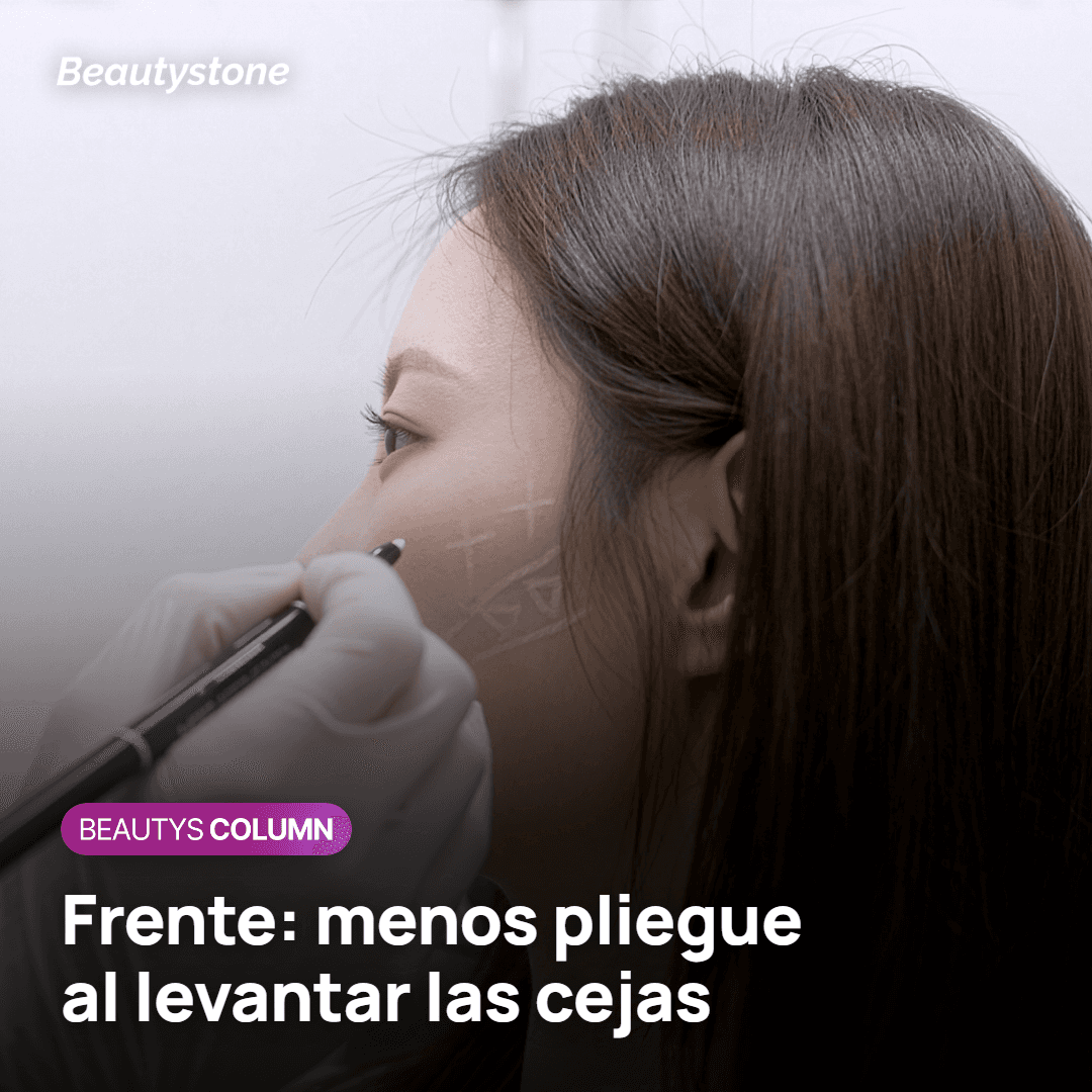 Botox en la frente: menos pliegue horizontal al levantar las cejas