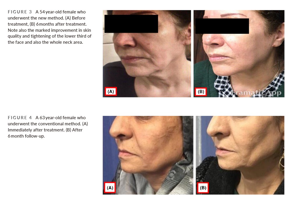 ultherapy results after 6 months