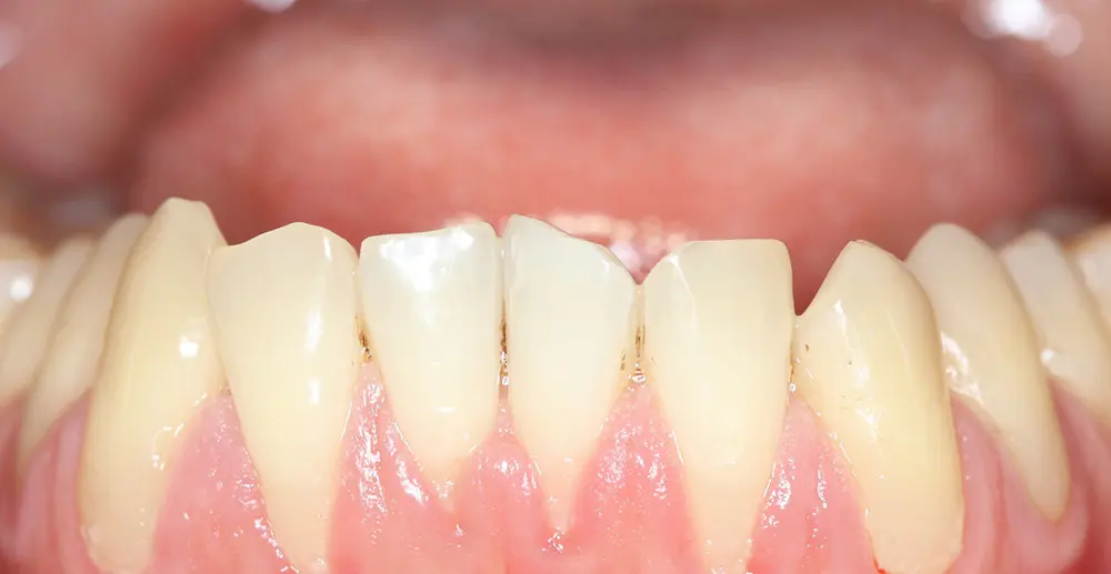 Retração Gengival: o que é?
