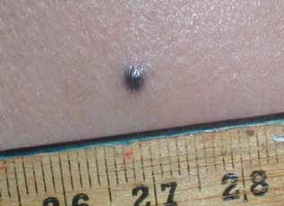 Figure 7: Blue naevus