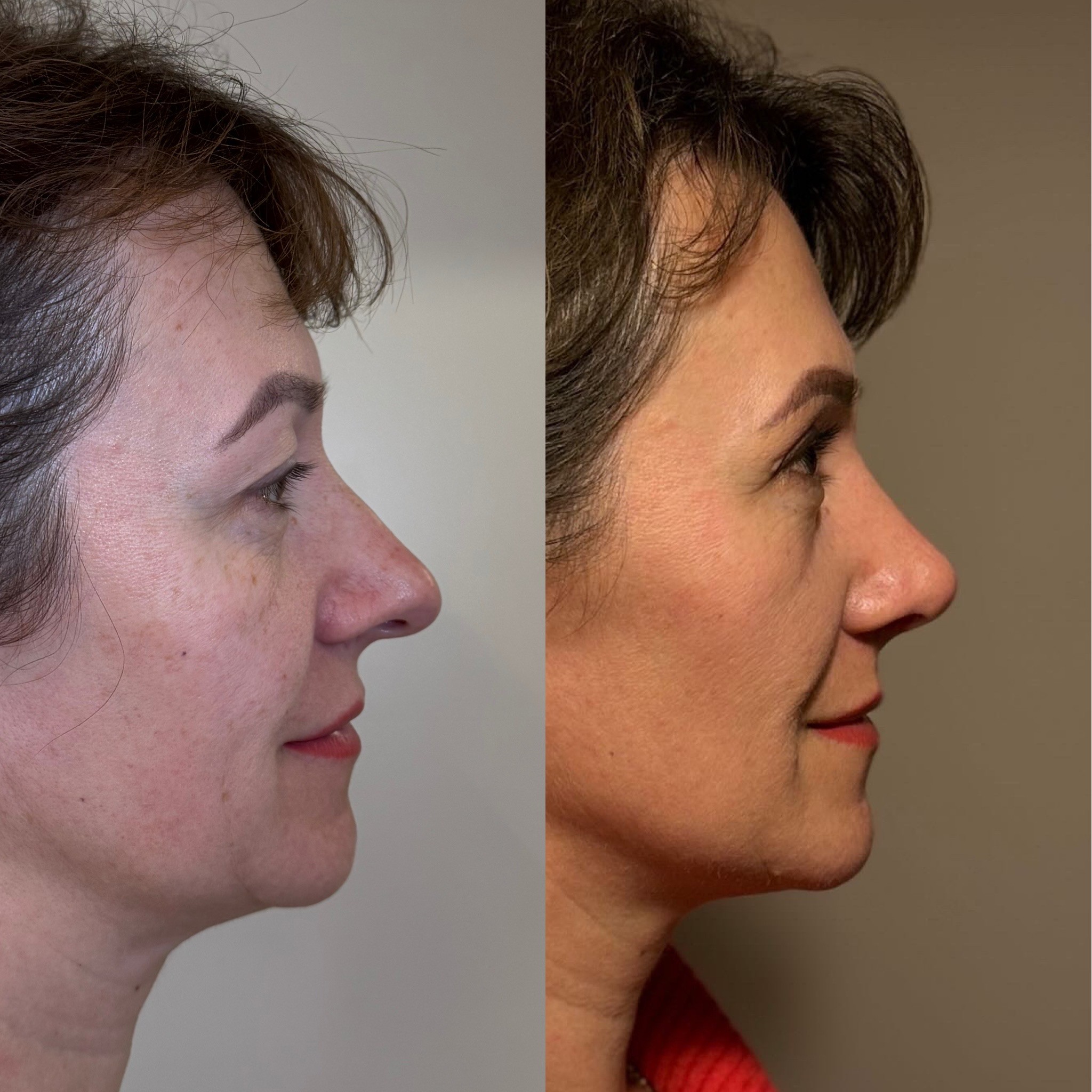 1 month after revision rhinoplasty before after right side view