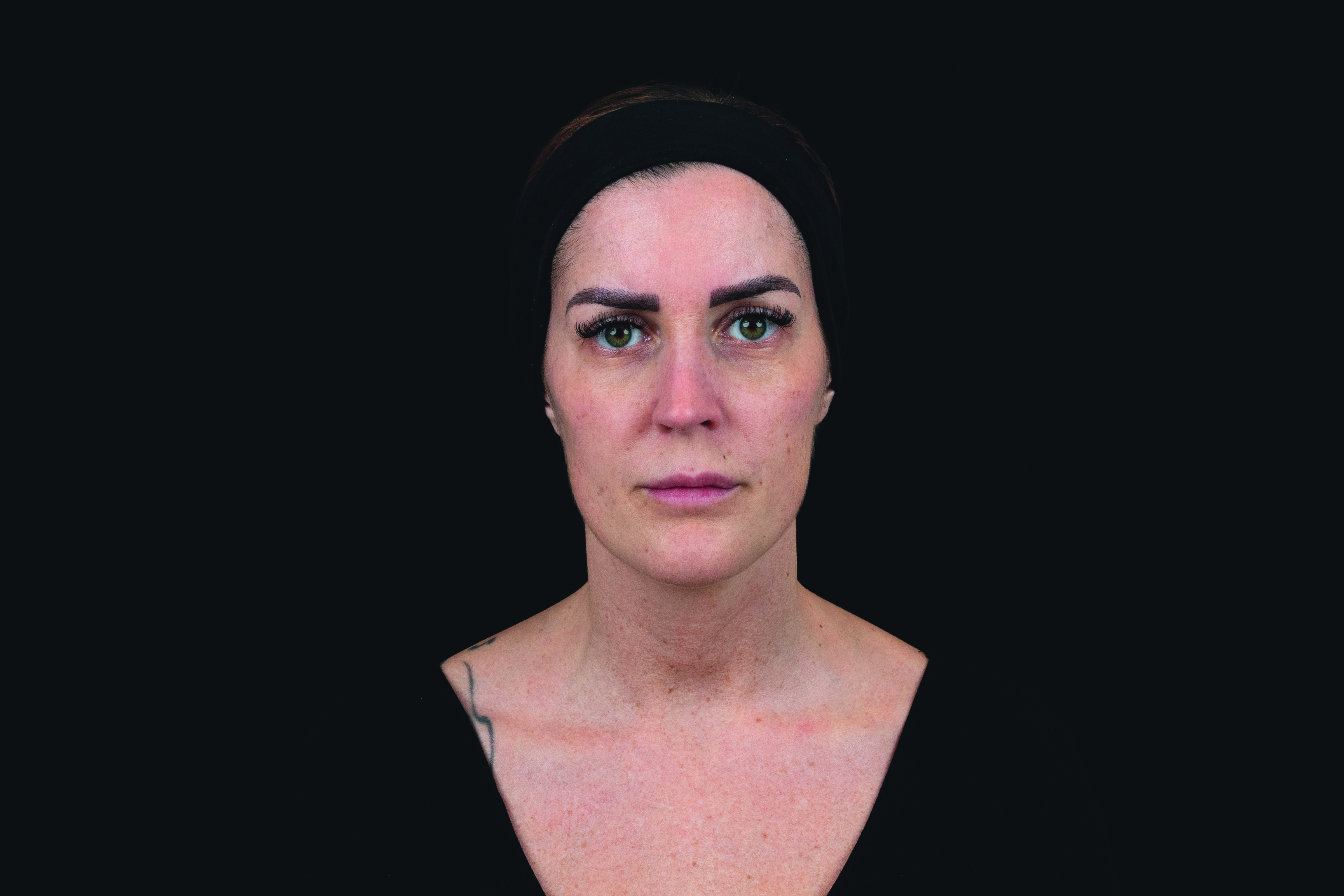 After treatment frontal view of female patient following Croma Saypha Volume Plus Lidocaine dermal filler application