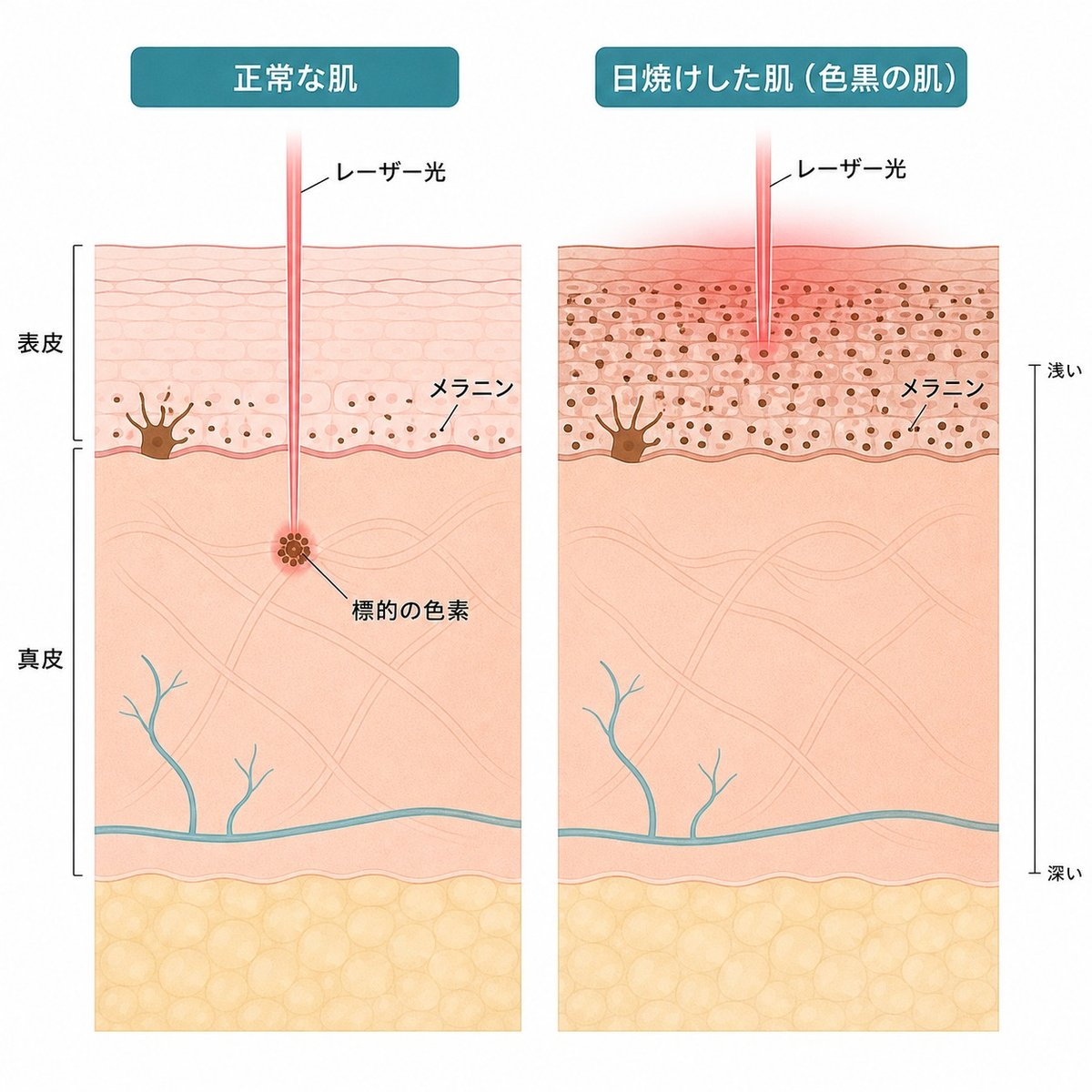 通常の肌と日焼けした肌で、シミのレーザーのエネルギーが吸収される位置の違いを示した断面図