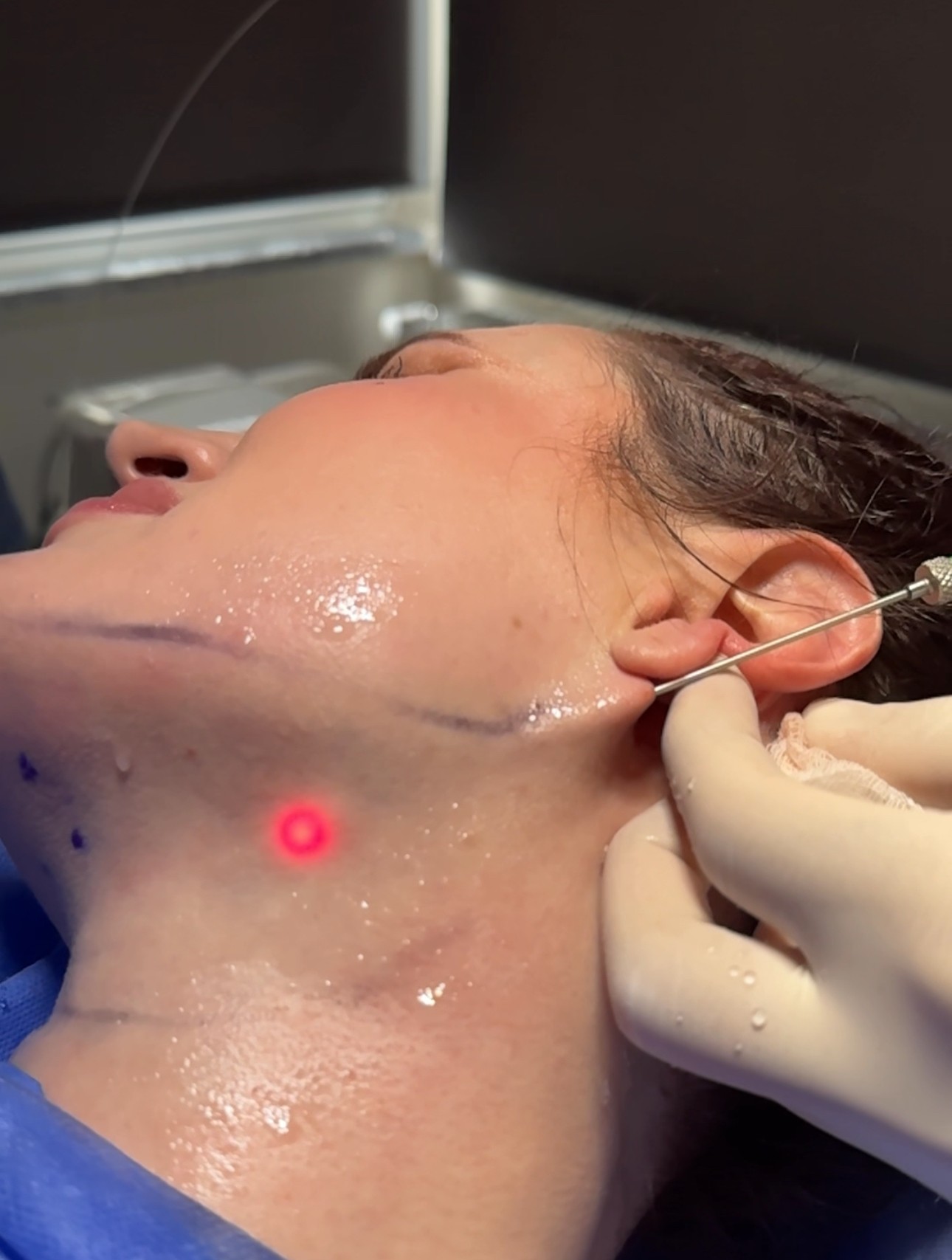 endolift laser tightening