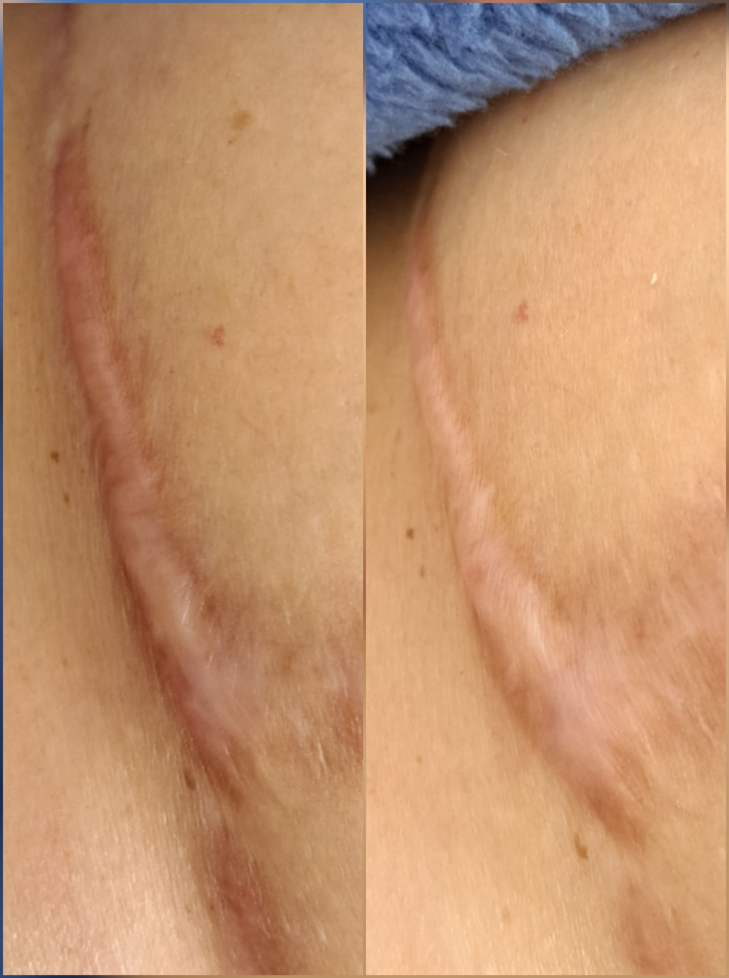 Neuroscars terapia_blizn_neurolifting_neurorehabiltacja_szczecin_wrocÅaw_estGen_leszczenko_efekt_jednego_zabiegu