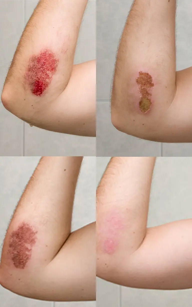 Before and after treatment - hand