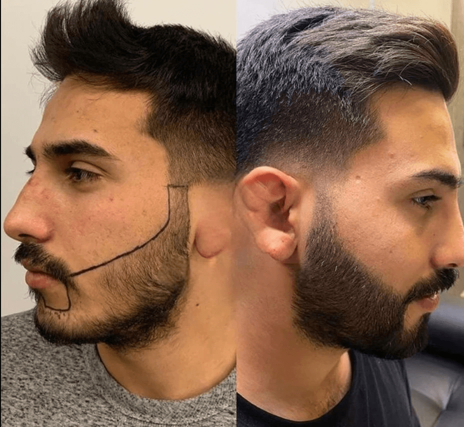 Beard Transplant 