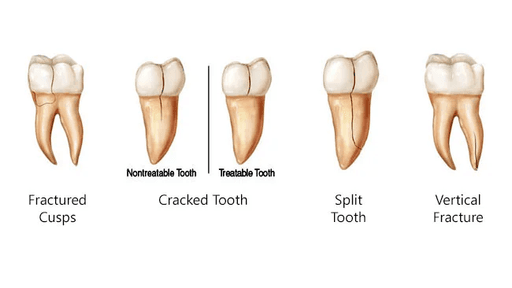 description of cracked teeth