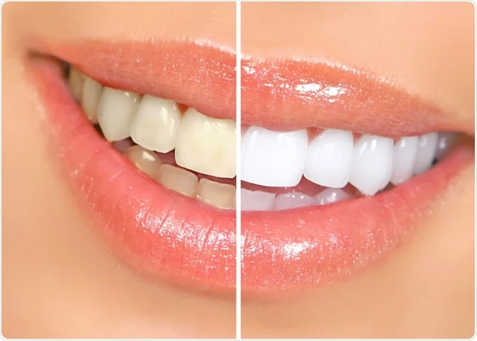 teeth whitening near me