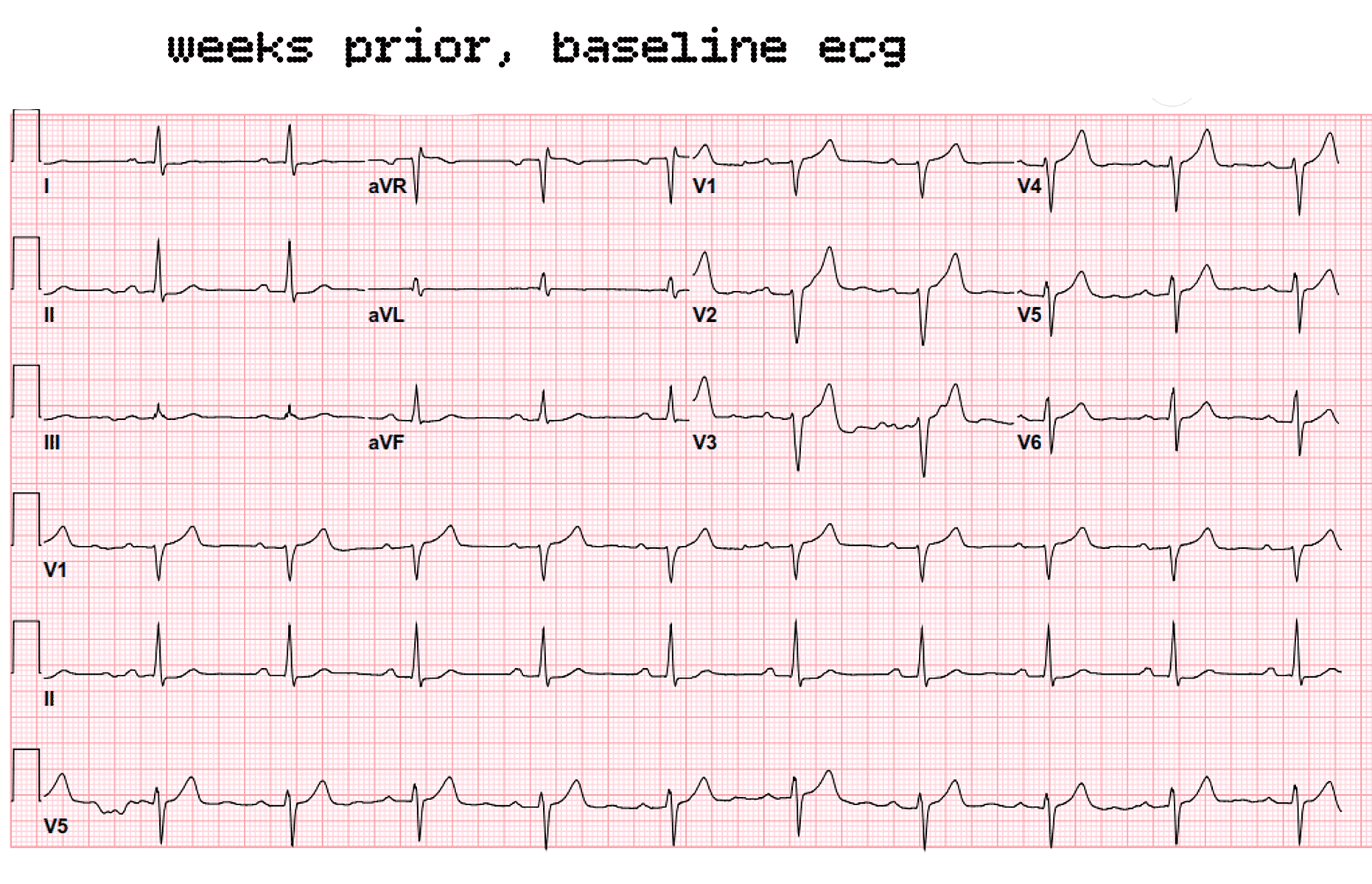 baseline ecg