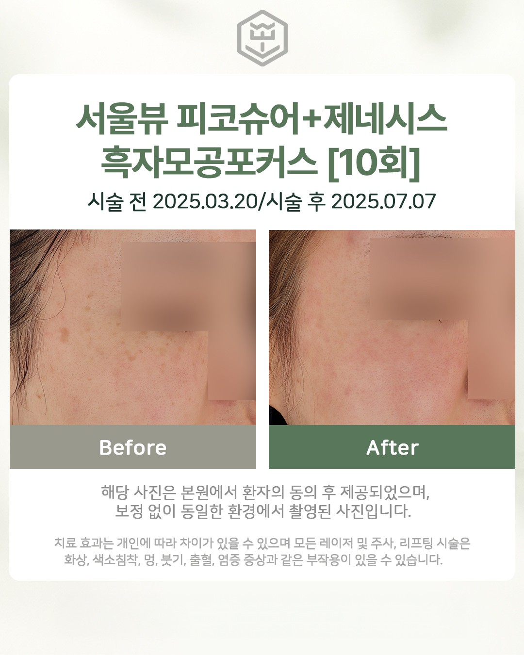 피코슈어+제네시스+흑자모공포커스 10회