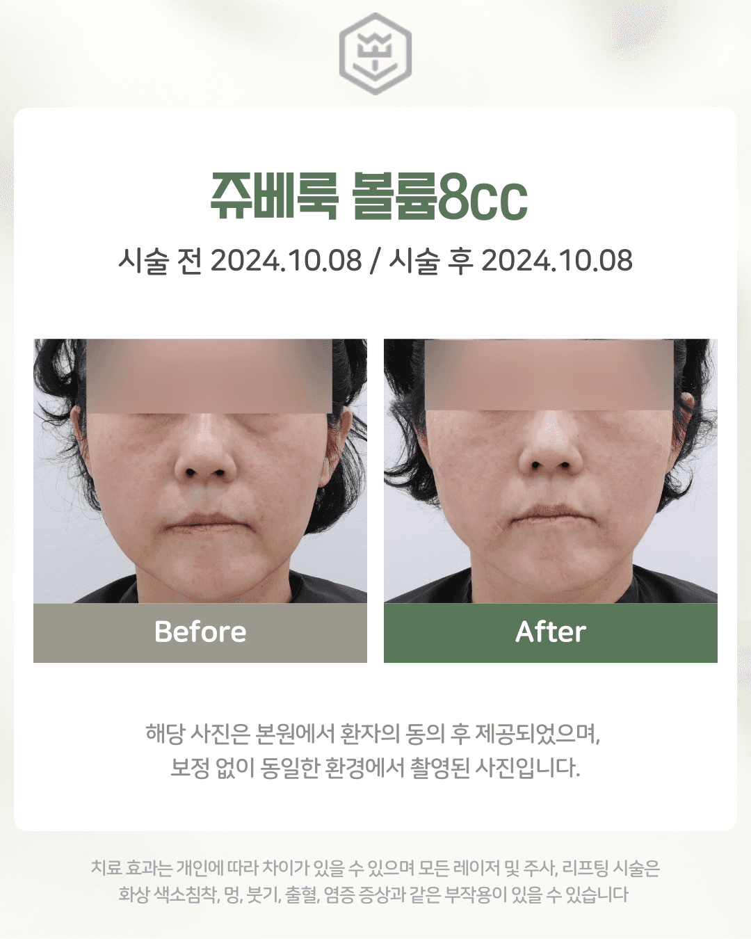 쥬베룩볼륨 8cc