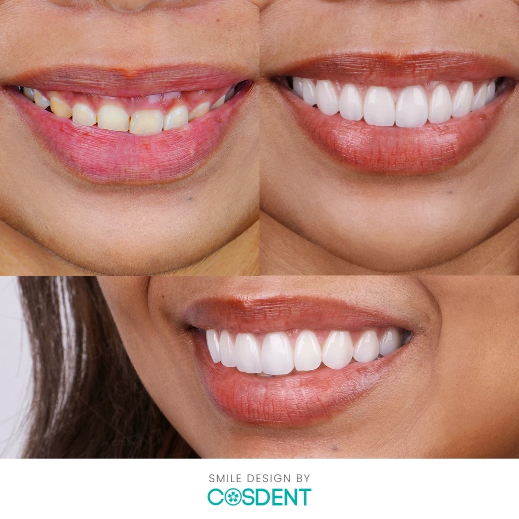 รีวิวออกแบบรอยยิ้ม ที่ cosdent smile design