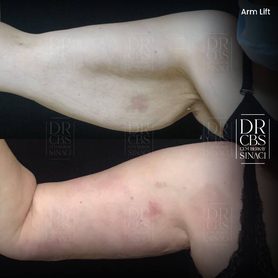 2 weeks post-op arm lift (brachioplasty) before after front view