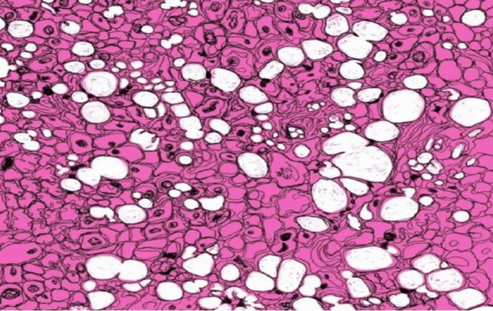 Fatty liver