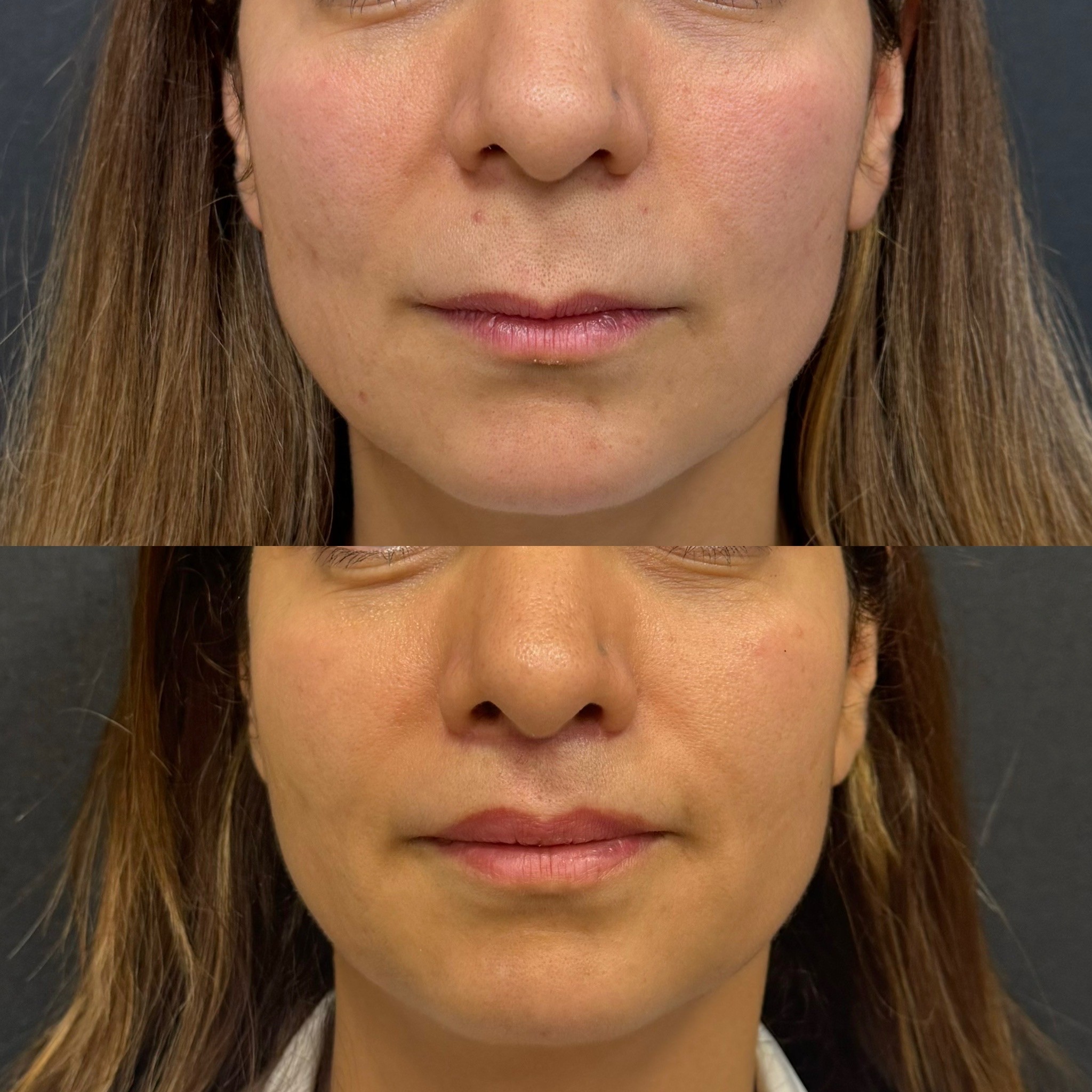 2 months post-op lip lift before after front view