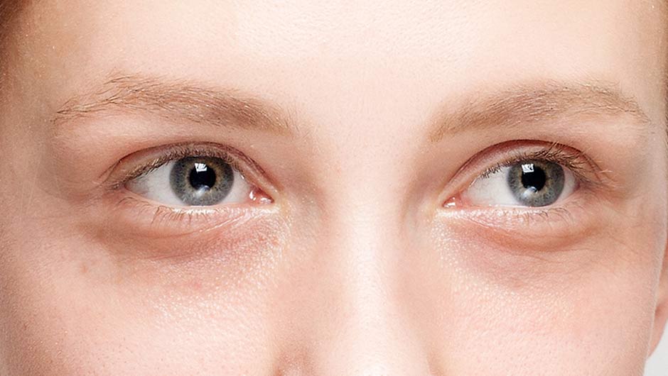 Eye area rejuvenated with hyaluronic acid filler treatment to reduce fine lines and refresh tired-looking skin.