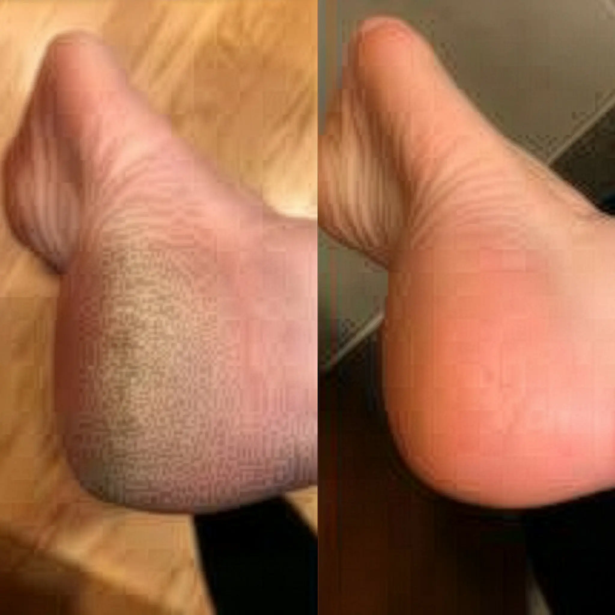 Before and after treatment - arm