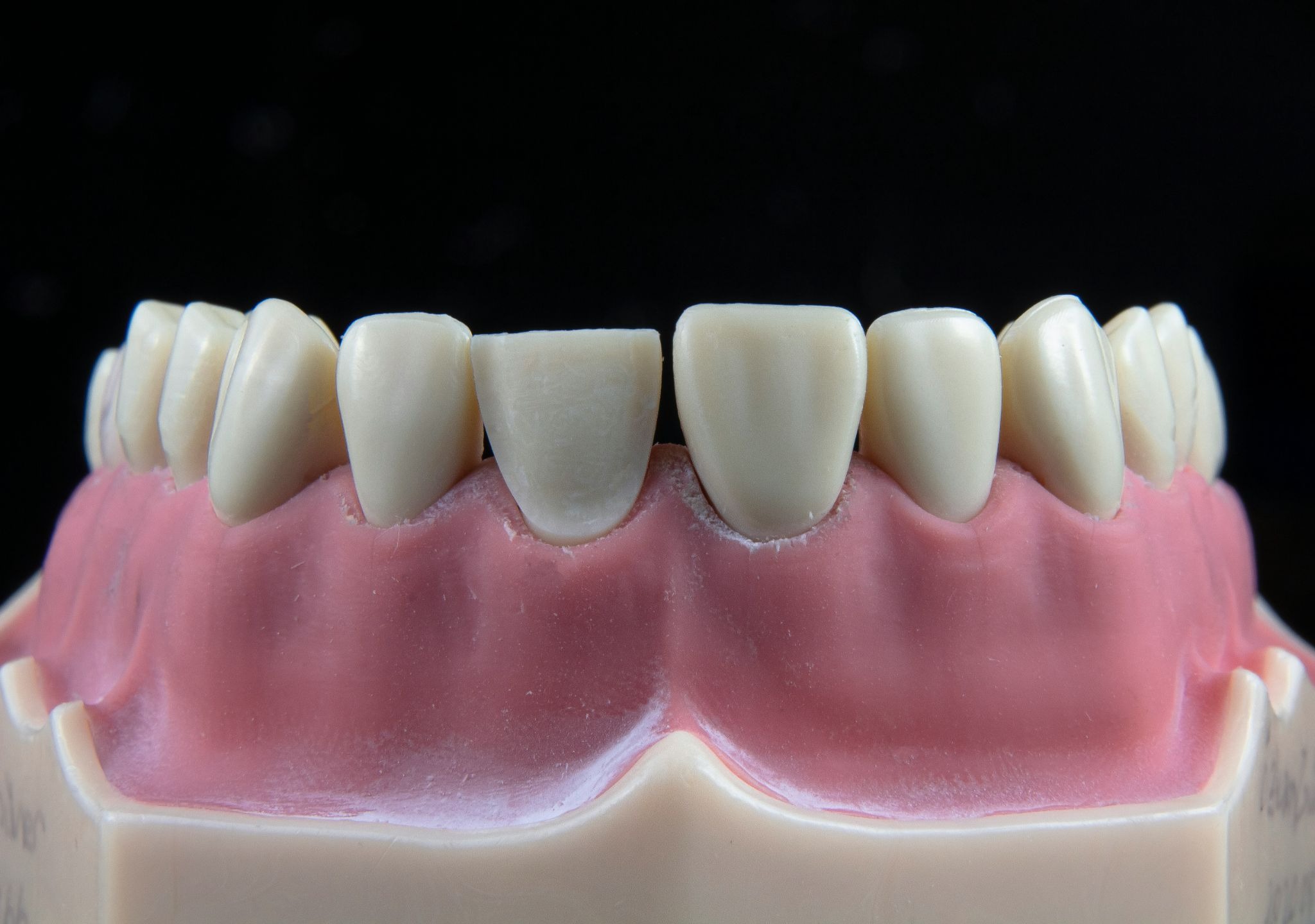 Best Ways to Address Teeth Gap Filling