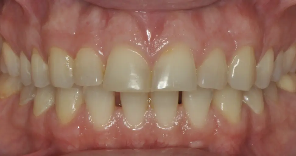 Before ortho treatment