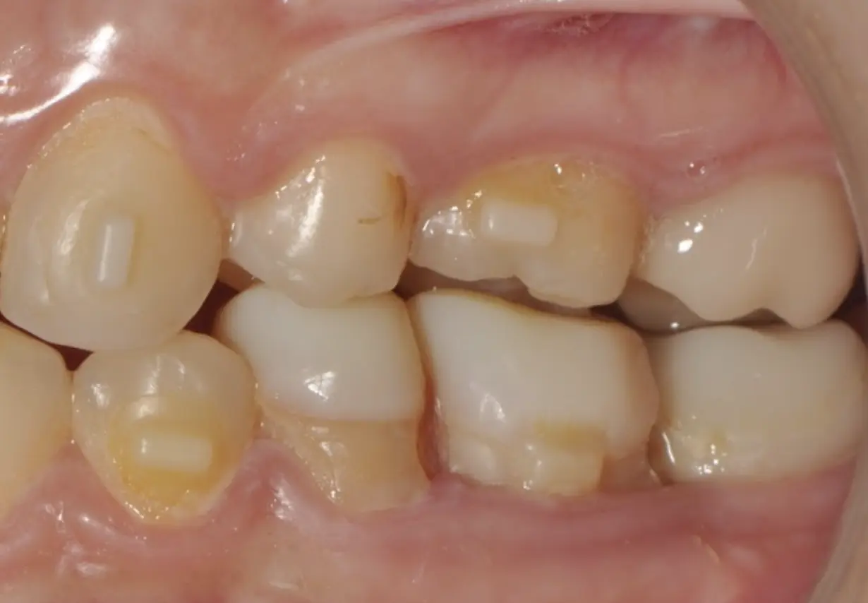 Temporary crowns on posterior teeth, changing old composite restorations, composite onlays (before and after)