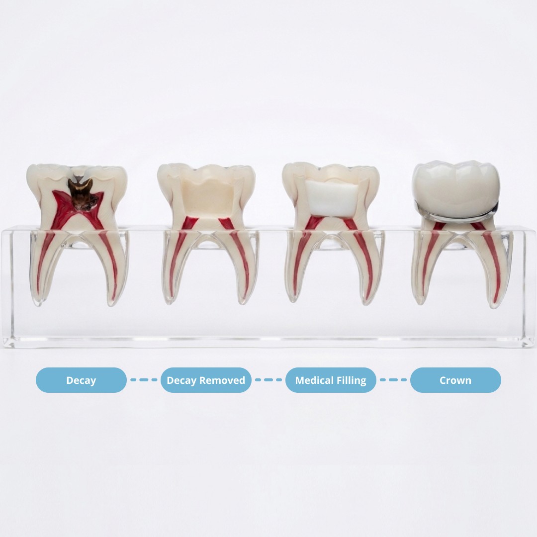 Dental model showing the stages of pulp therapy from decay removal to a medical filling and protective crown.