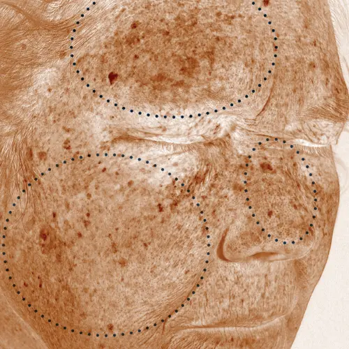 After pigmentation discolouration treatment at The Vancouver Aesthetician — skin analysis confirming dermal and surface discolouration significantly reduced across all skin layers