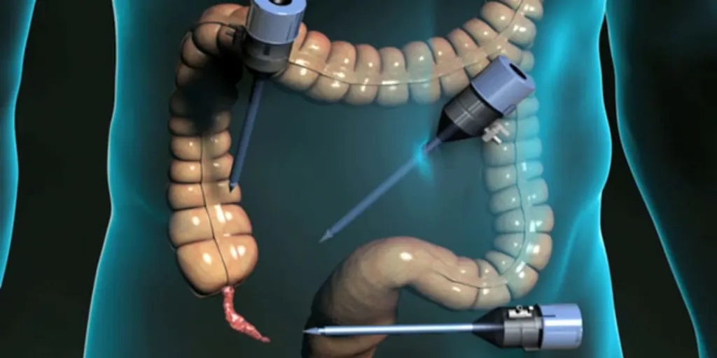 Laparoscopic Appendectomy