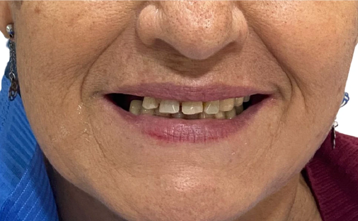 Paciente de Distrito Dental antes de hacerse un implante dental