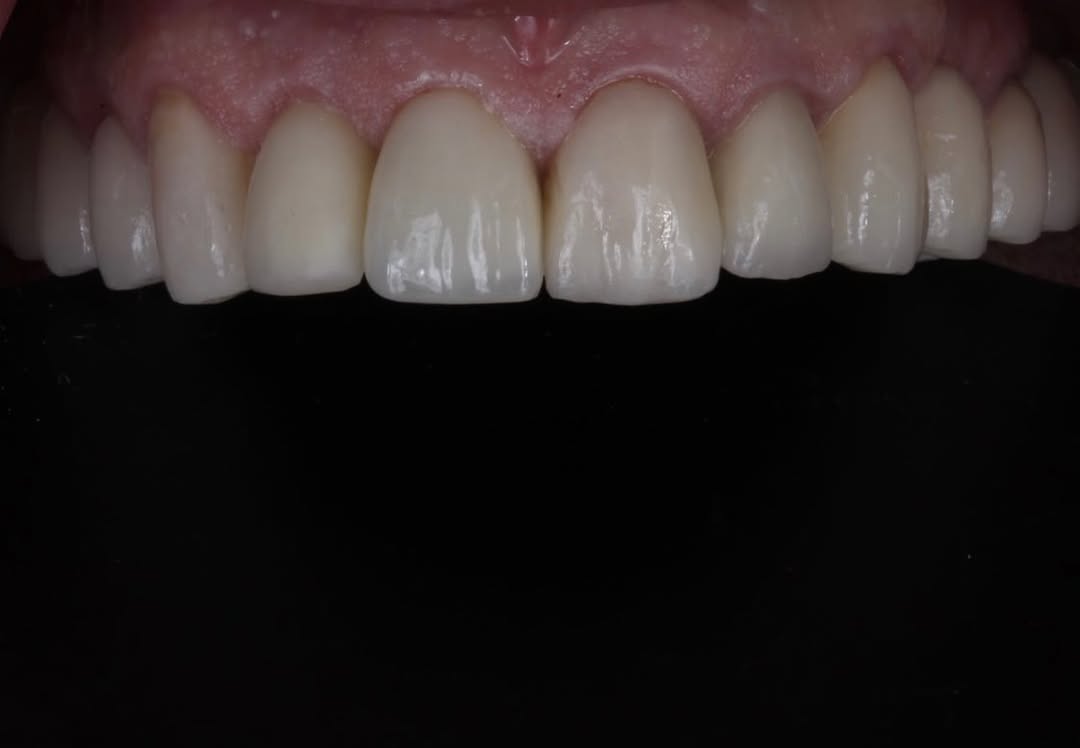 gum contouring
