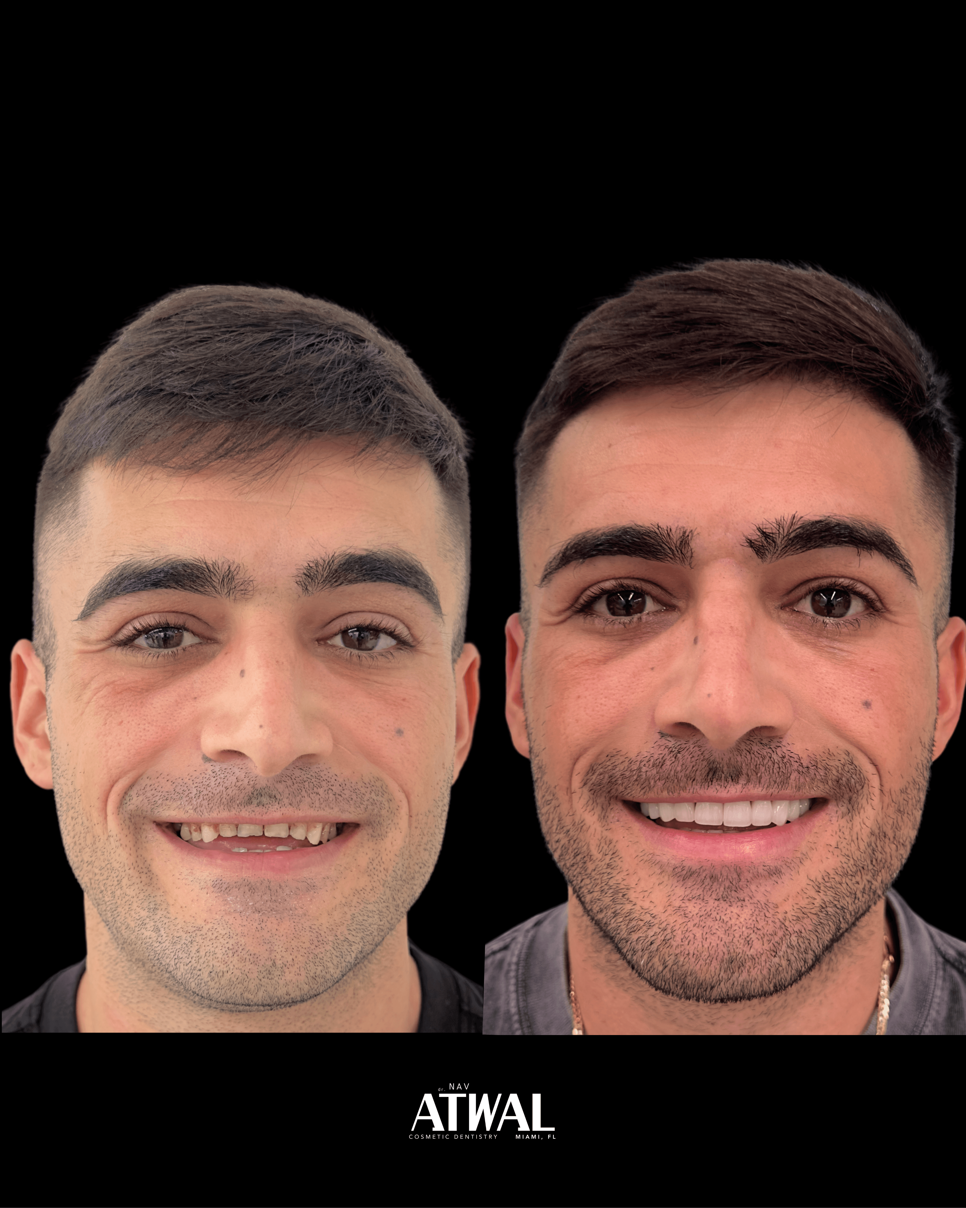 Full-mouth rehabilitation with veneers and crowns — Miami
