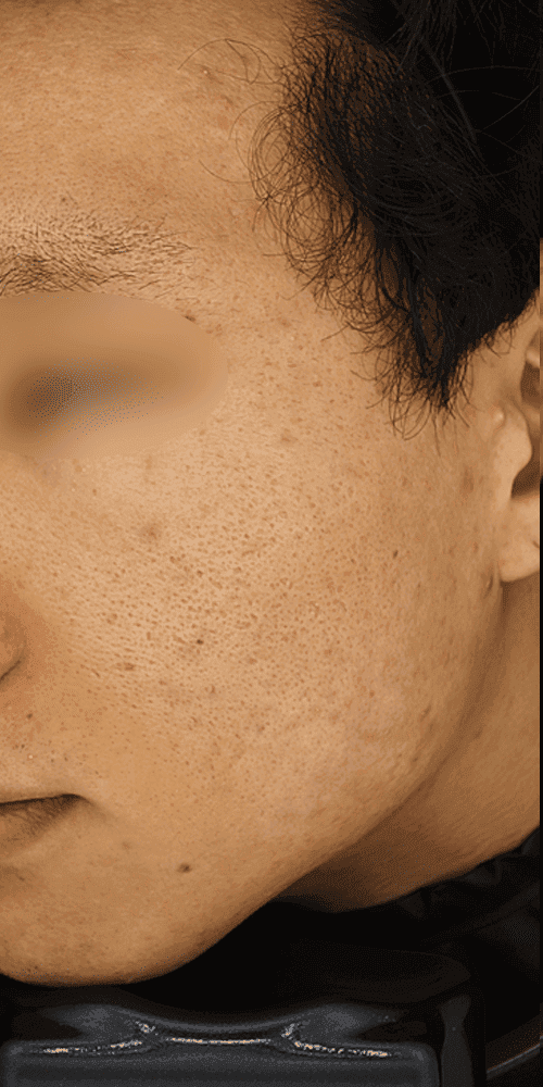 Acne - After