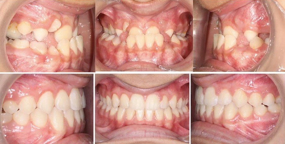 Invisalign Center in Dubai with invisalign® before and after photo shows corrected underbite and closed gaps between front teeth.
