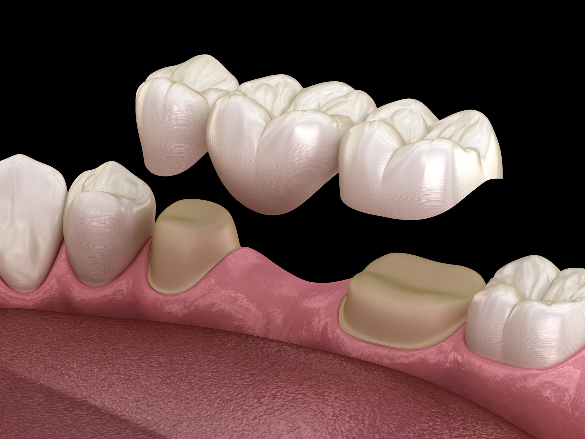 Dental bridge for missing or compromised teeth