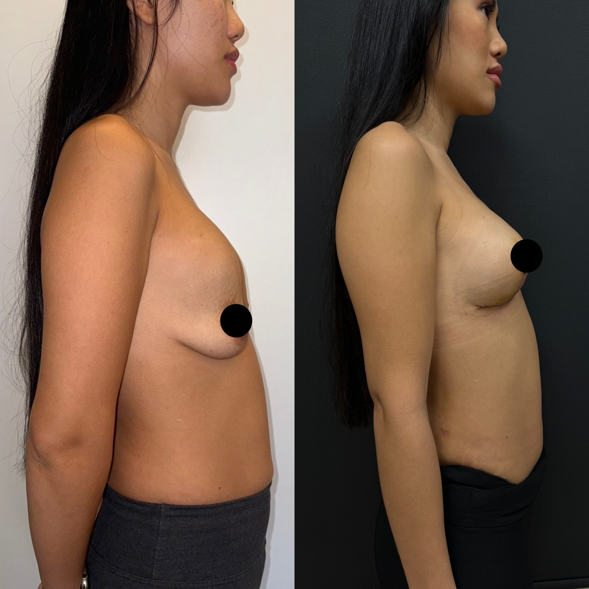 breast implant change and lift before after side view