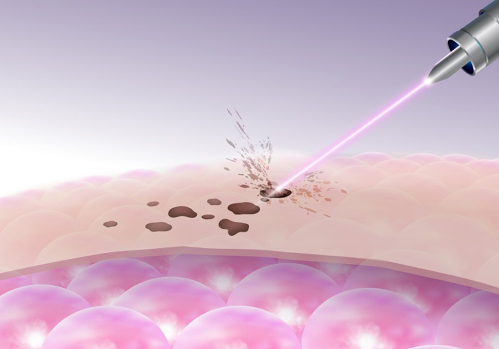 pigmentation laser treatments 