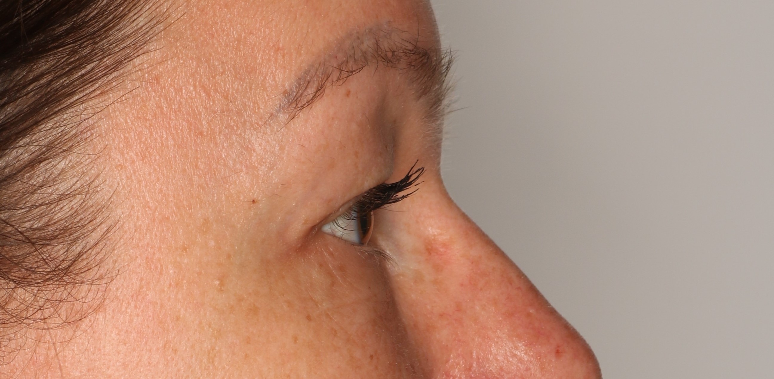 Efekt zabiegu plastyka powiek górnych - Przed