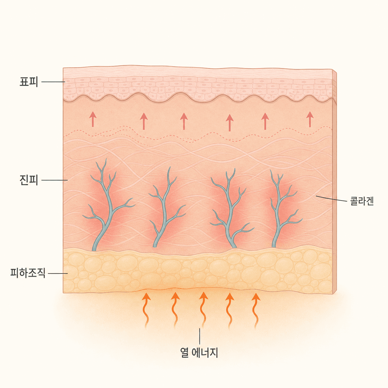 고주파 열 에너지가 진피에 전달되며 붓기와 홍조가 생기는 기전