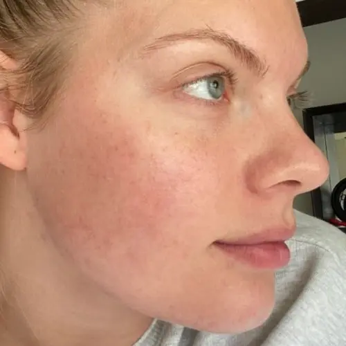 After acne treatment at The Vancouver Aesthetician — papules, blackheads and whiteheads completely cleared and skin visibly healthy and smooth