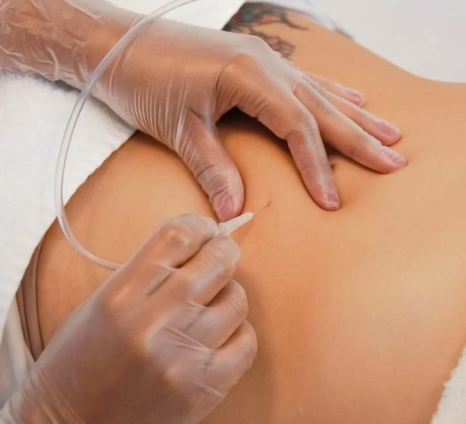 Carboxiterapia