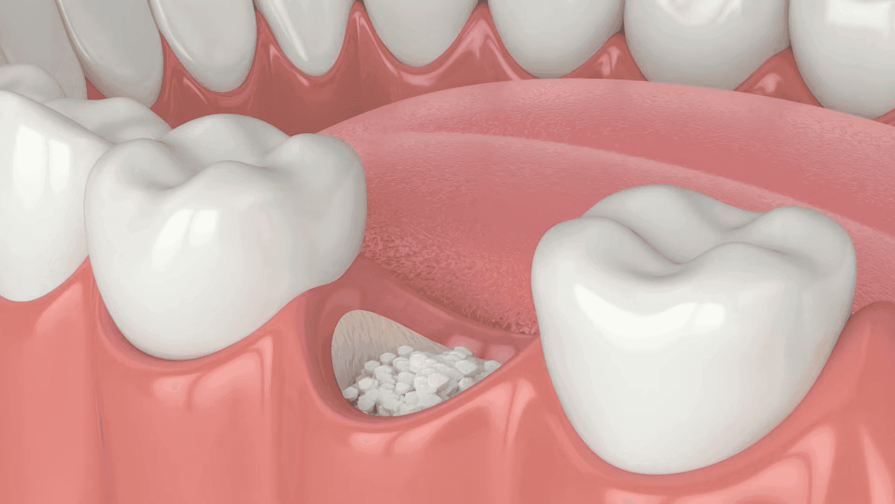 Bone Grafting in North York at Sovrle Dental Clinic in North York, Ontario