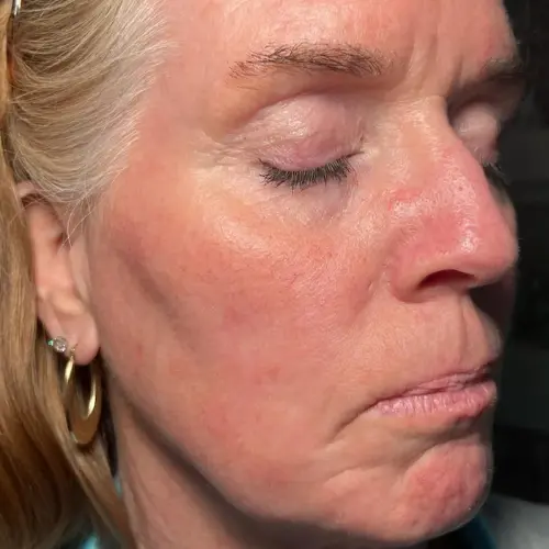 After lymphatic drainage facial at The Vancouver Aesthetician — rosacea calmed, puffiness reduced, healing visibly accelerated and skin noticeably healthier through restored lymphatic function