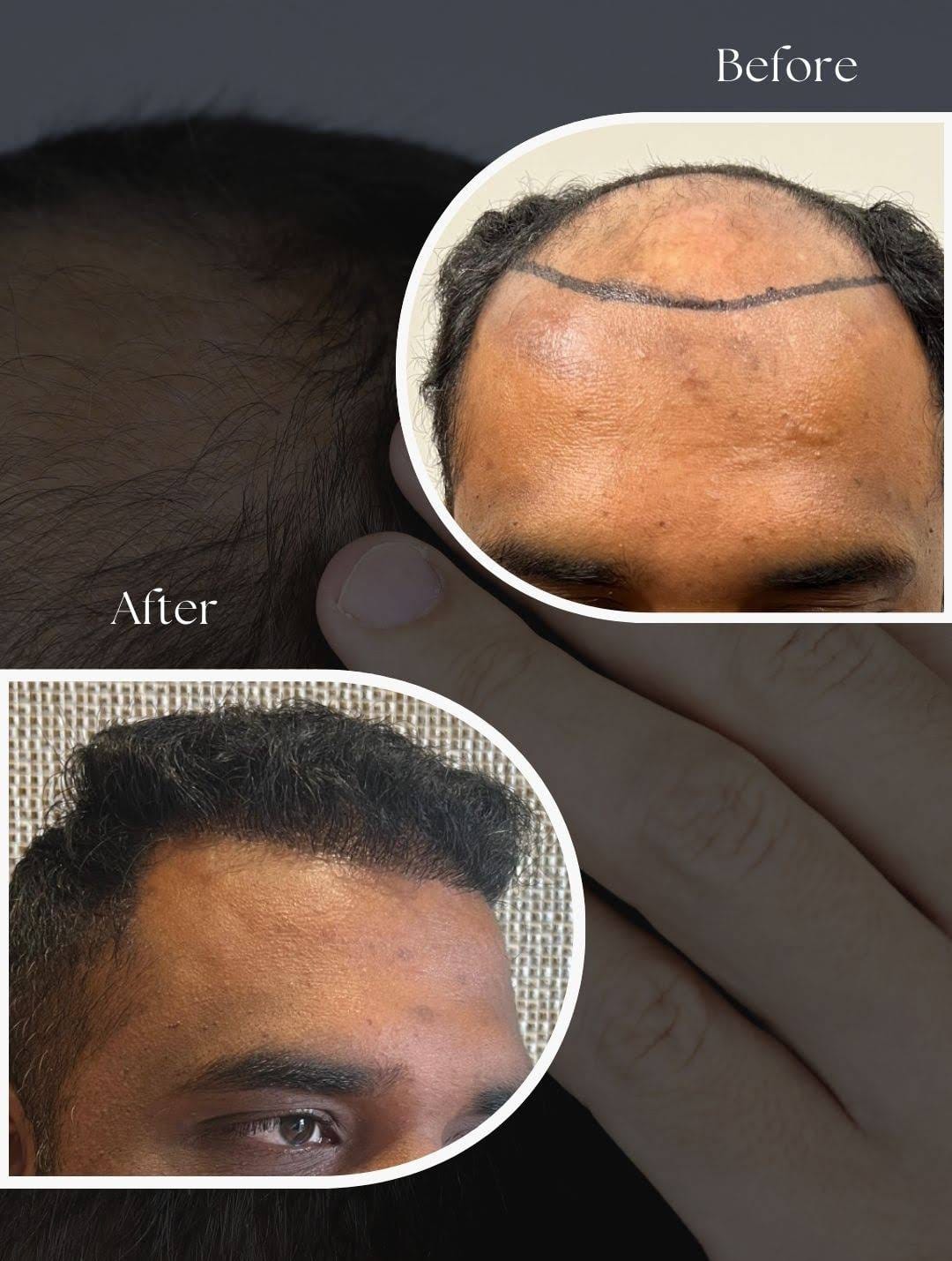 Gentle foam wash after 7 days of hair transplant