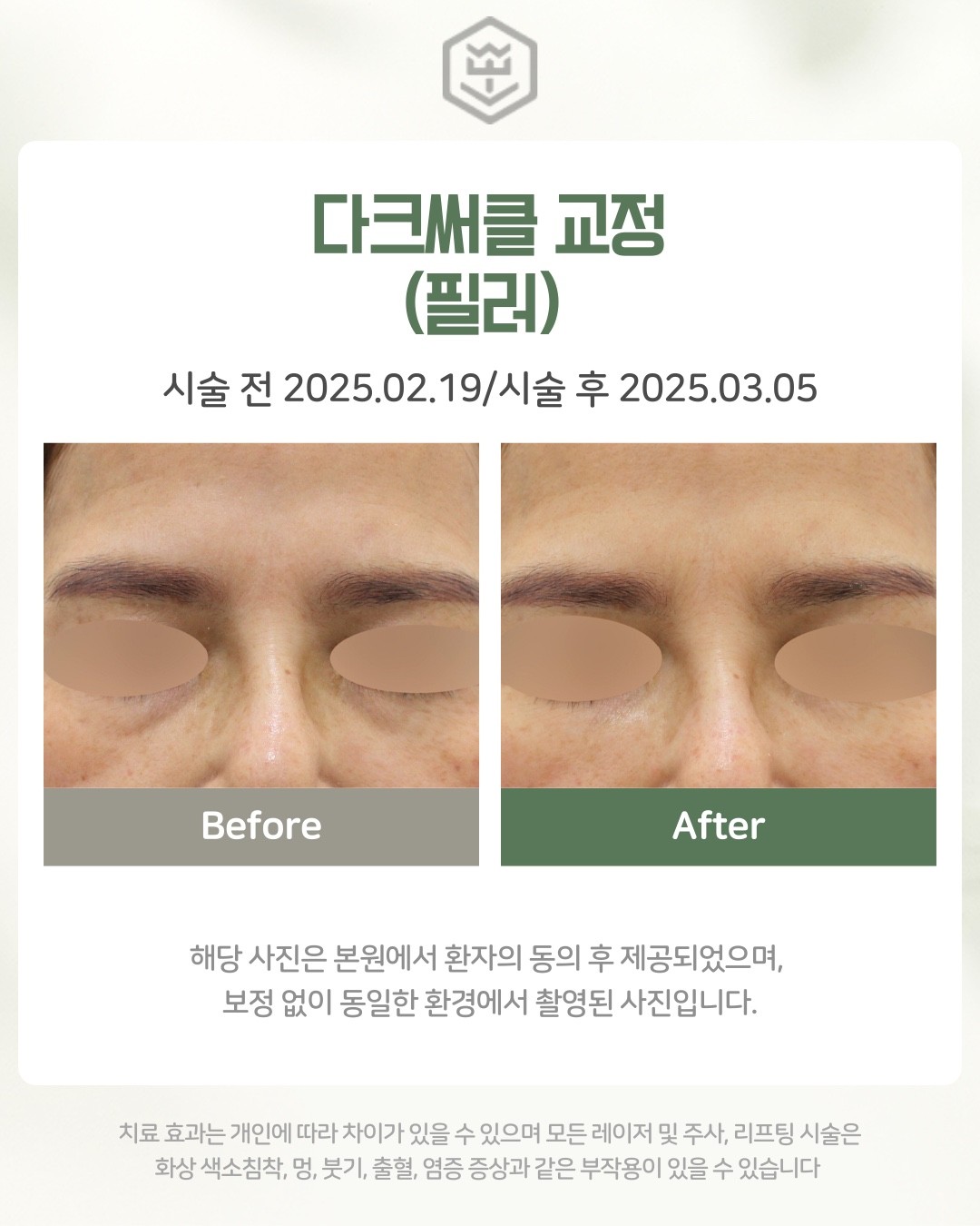 다크서클 교정(필러)