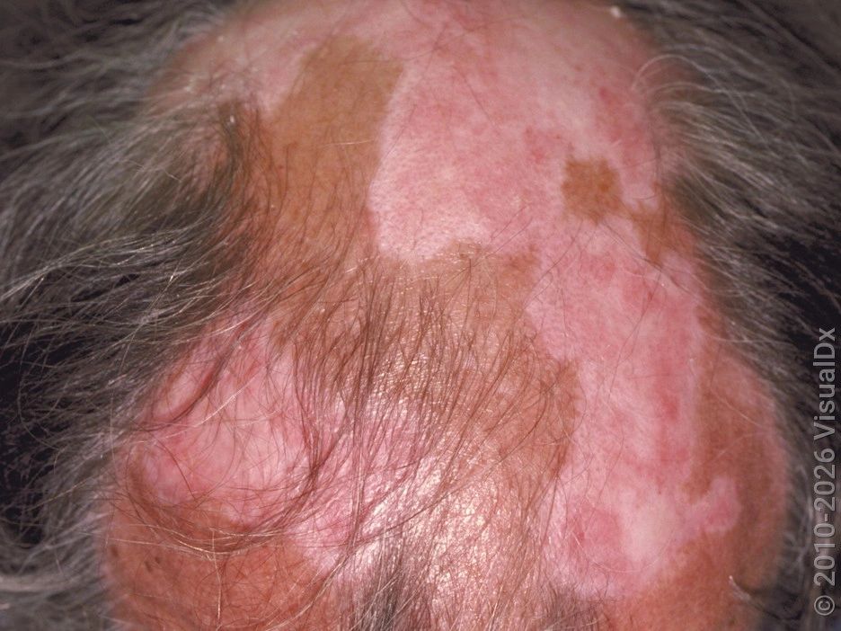Discoid Lupus Erythematosus — image from NorCal Hair Doctor™'s existing website